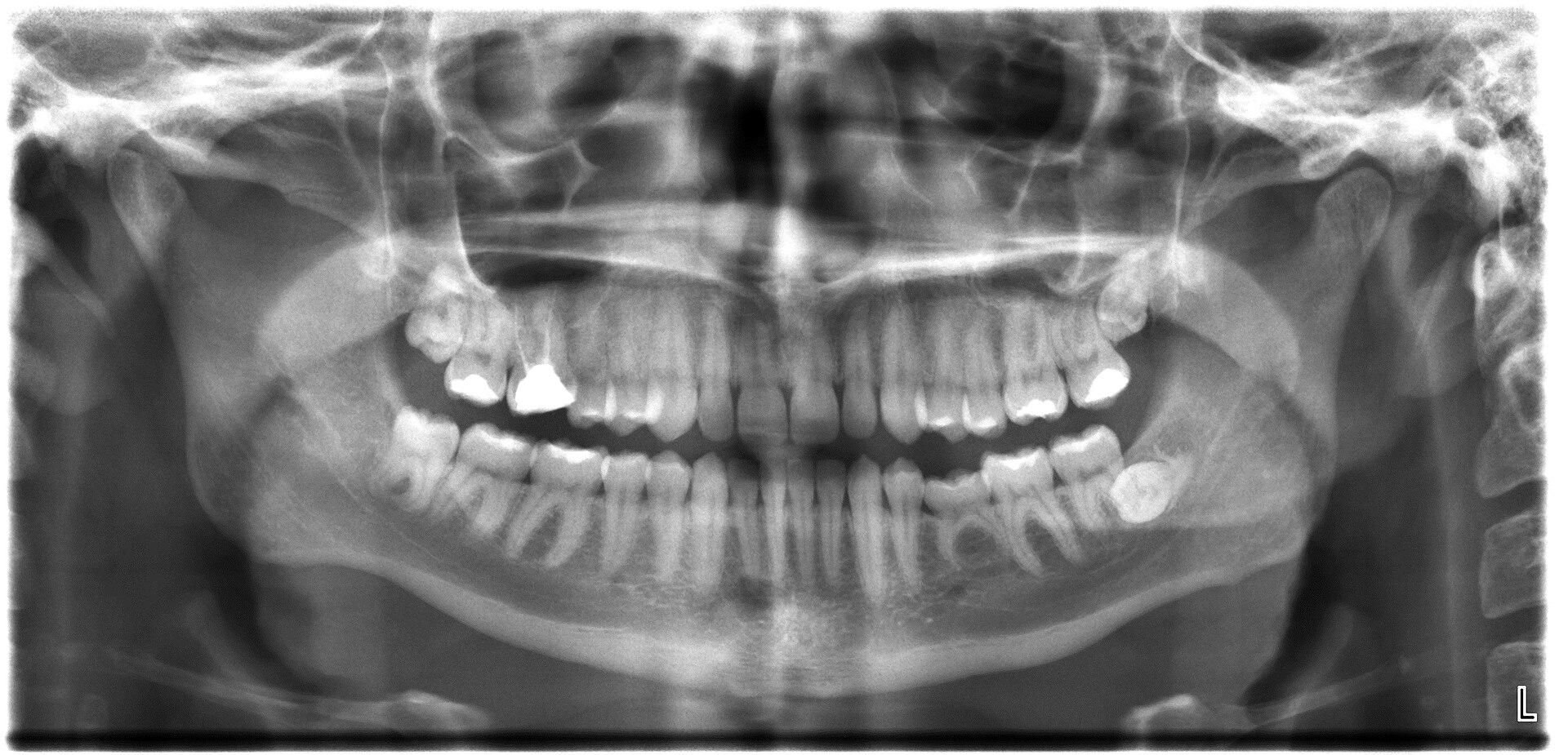 Panoramic dental X-ray